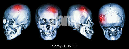 CT scan of human skull and 3D with Stroke (cerebrovascular accident) Stock Photo