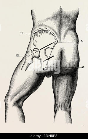 Incision Wikipedia incisions, medical equipment, surgical instrument, history of medicine ...