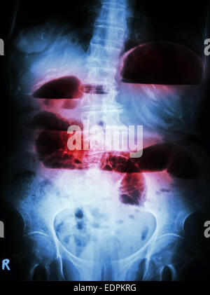 Film X-ray abdomen upright show small bowel dilated and air-fluid level in small bowel due to small bowel obstruction Stock Photo