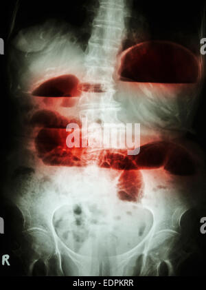 Film X-ray abdomen upright show small bowel dilated and air-fluid level in small bowel due to small bowel obstruction Stock Photo