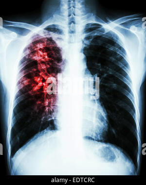 film chest x-ray PA upright : show interstitial infiltration at right lung due to mycobacterium tuberculosis infection (Pulmonar Stock Photo