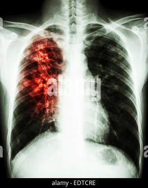 film chest X-ray PA upright : show pleural effusion at right lung due ...