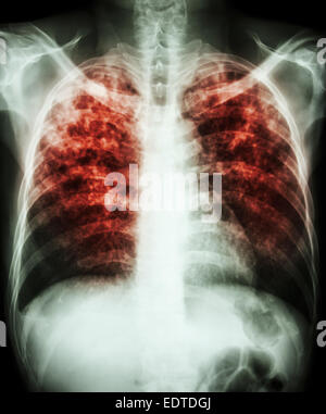 'Pulmonary tuberculosis'  Film chest x-ray show interstitial infiltration both lung due to mycobacterium tuberculosis infection Stock Photo