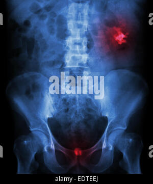 Left kidney stone(opaque area at right upper of image) and bladder stone(opaque area at lower of image) Stock Photo