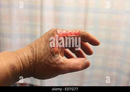 male left hand has accident, second degree burn, healing wound on left hand, Norfolk, UK Stock Photo