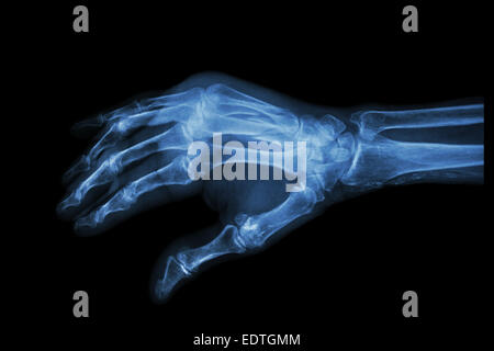 Film X-ray hand oblique  :  Fracture at 3rd and 4th metacarpal bone Stock Photo