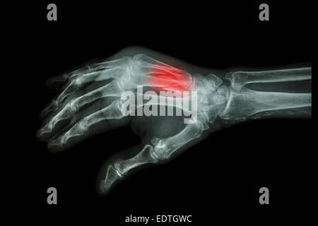 Film X-ray hand oblique  :  Fracture at 3rd and 4th metacarpal bone Stock Photo