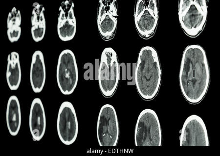 film CT scan of brain show ischemic stroke and hemorrhagic stroke Stock Photo