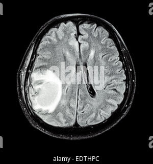 MRI brain : show brain tumor at right parietal lobe of cerebrum Stock Photo