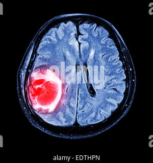 MRI brain : show brain tumor at right parietal lobe of cerebrum Stock Photo