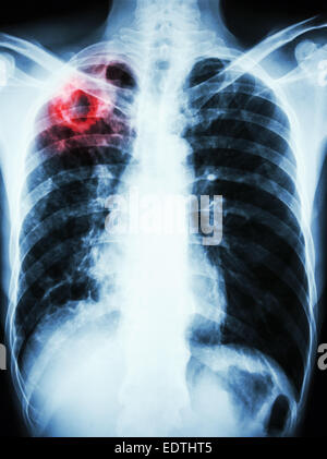 film chest x-ray show cavity at right upper lung due to Mycobacterium tuberculosis infection (Pulmonary Tuberculosis) Stock Photo