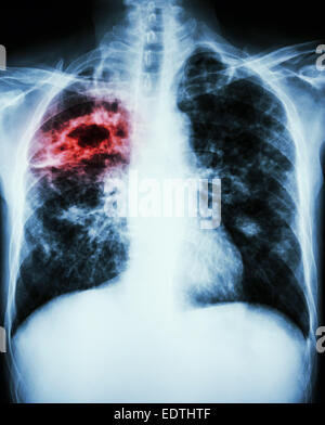 film chest x-ray show cavity at right lung,fibrosis & interstitial & patchy infiltrate at both lung due to Mycobacterium tubercu Stock Photo