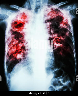 film chest x-ray show cavity at right lung,fibrosis & interstitial & patchy infiltrate at both lung due to Mycobacterium tubercu Stock Photo