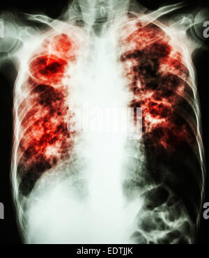 film chest x-ray show cavity at right lung,fibrosis & interstitial & patchy infiltrate at both lung due to Mycobacterium tubercu Stock Photo