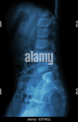 Lumbar spine of child ( X-ray thoracic - lumbar spine ) ( lateral view ) Stock Photo