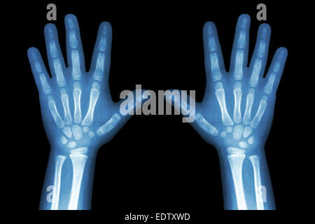 X-ray both child hands on black background Stock Photo