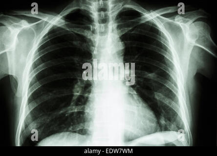 film X-ray show normal human's chest  (bone and internal organ) Stock Photo
