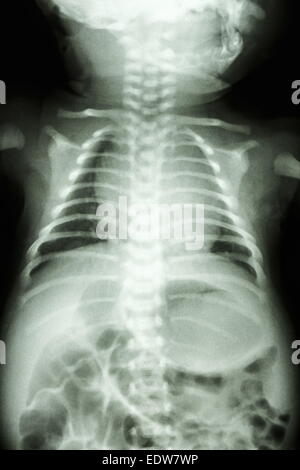 film X-ray show normal chest of infant Stock Photo