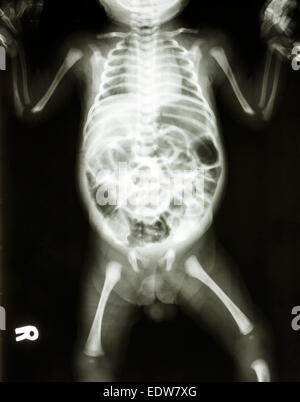 film X-ray show normal skeleton of infant Stock Photo