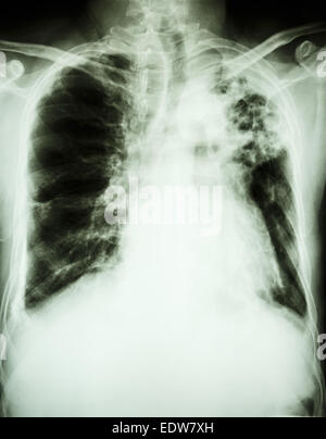 film X-ray show left lung abscess from Burkholderia pseudomallei Stock ...