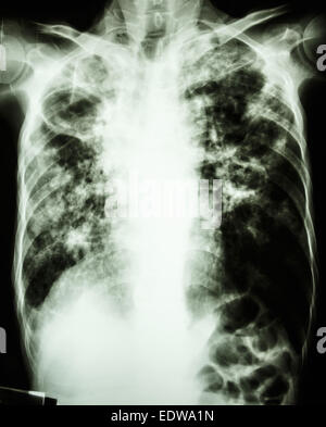 film chest x-ray show cavity at right lung,fibrosis & interstitial & patchy infiltrate at both lung due to Mycobacterium tubercu Stock Photo