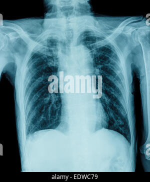 A chest xray film of a patient with cardiac pacemaker, also with ...