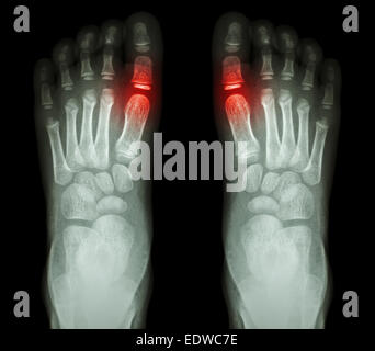 'Rheumatoid arthritis , Gouty arthritis'  X-ray child's foots and arthritis at metatarsophalangeal joint (Big toe area) Stock Photo