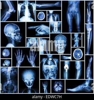 Collection X-ray part of human,Orthopedic operation,Multiple disease (Fracture,Gout,Rheumatoid arthritis,Osteoarthritis knee,Str Stock Photo