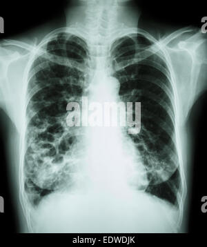 'Bronchiectasis'  X-ray chest show : multiple lung bleb and cyst due to chronic infection Stock Photo