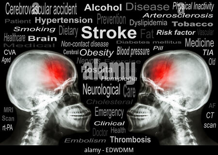 X-ray Skull with 'Stroke' and Medical text Stock Photo