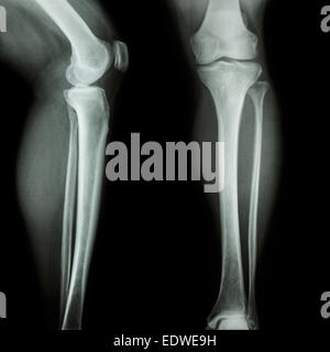 film x-ray leg & knee AP(Anterior-Posterior)/lateral Stock Photo