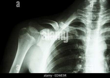film x-ray right clavicle(collarbone) : show fracture right clavicle Stock Photo
