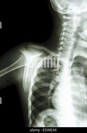 film x-ray transcapula Y view : show normal child's shoulder Stock Photo