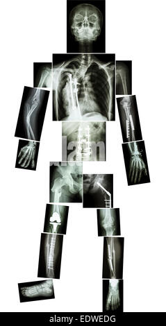 skeleton of human and multiple fracture. he was operated and internal fixed by plate and screw at multiple site Stock Photo