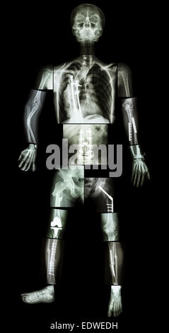 skeleton of human and multiple fracture. he was operated and internal fixed by plate and screw at multiple site Stock Photo