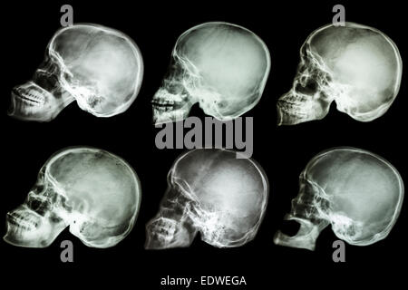 Collection of x-ray asian's skull Stock Photo