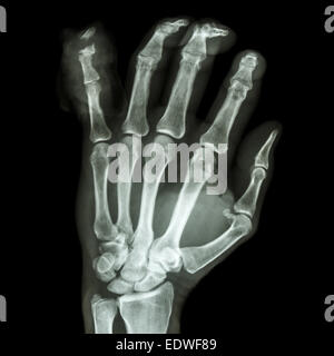 film x-ray hand AP : show fracture distal pharange little finger Stock Photo