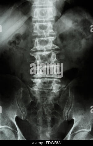 film x-ray L-S spine (lumbar-sacrum) : show normal human lumbar-sacrum ...