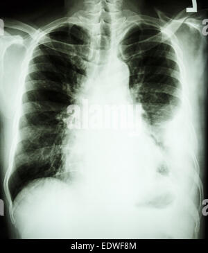 film chest X-ray PA upright : show pleural effusion at right lung due