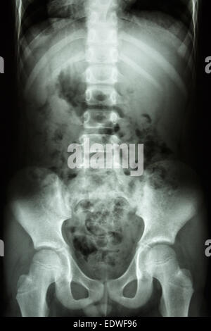 film x-ray show child's spine ,abdomen ,pelvis ,hip Stock Photo