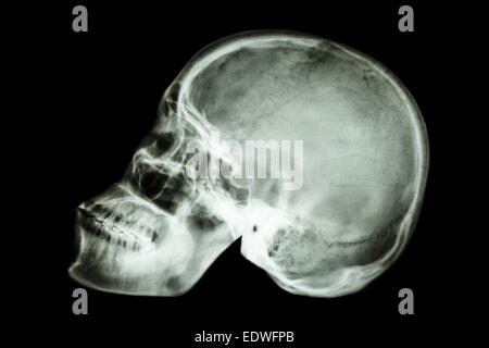 film x-ray normal human's skull (asian) Stock Photo