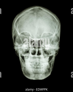 film x-ray skull AP : show normal asian human's skull (Thai people) Stock Photo