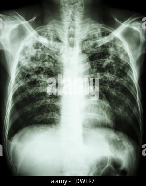 'Pulmonary tuberculosis'  Film chest x-ray show interstitial infiltration both lung due to mycobacterium tuberculosis infection Stock Photo