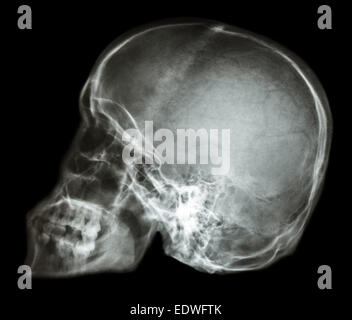 film x-ray skull lateral : show normal human's skull (Thai people) Stock Photo