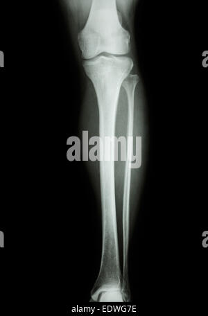 film x-ray normal human's leg Stock Photo