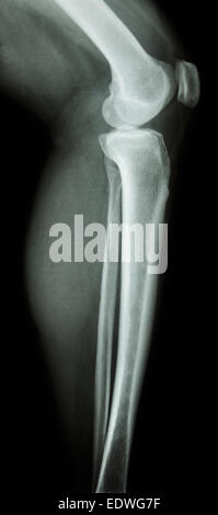 film x-ray knee lateral : normal human's knee&leg Stock Photo