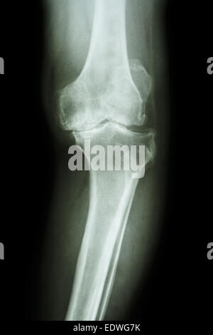 film x-ray knee AP of osteoarthritis knee patient (OA knee) Stock Photo