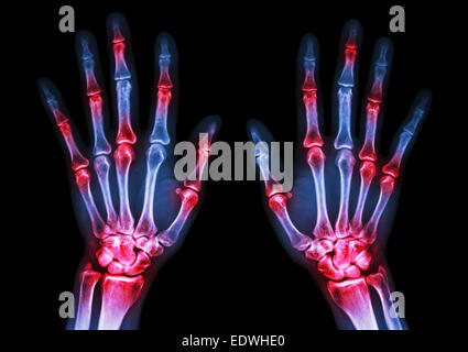 film x-ray both human's hands and arthritis at multiple joint (Gout,Rheumatoid) Stock Photo