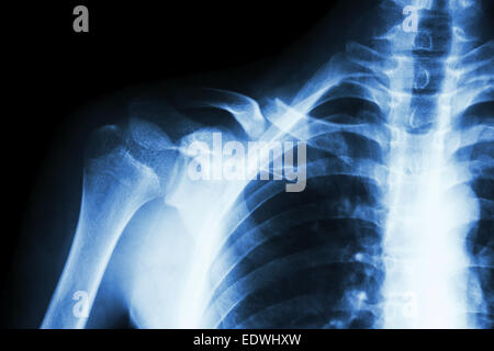 film x-ray right clavicle(collarbone) : show fracture right clavicle Stock Photo