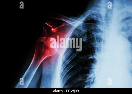 X-ray anterior shoulder dislocation Stock Photo